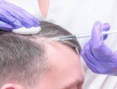 scalp of man being injected with PRP