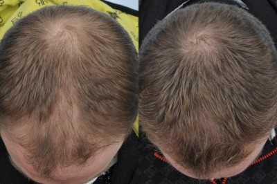 man showing before and after PRP treatment