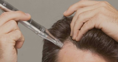 scalp having micro needle treatment